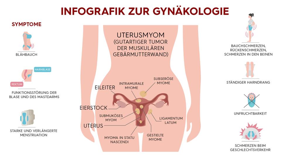 Unterleibskrebs - Symptome für Gebärmutterkrebs, Gebärmutterhalskrebs,  Eierstockkrebs